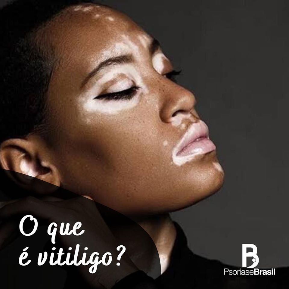 O que é vitiligo? | Minha Segunda Pele para Mundo Estranho